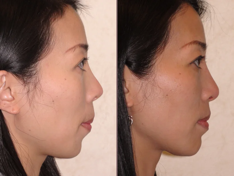 Chin Augmentation_00001.jpg