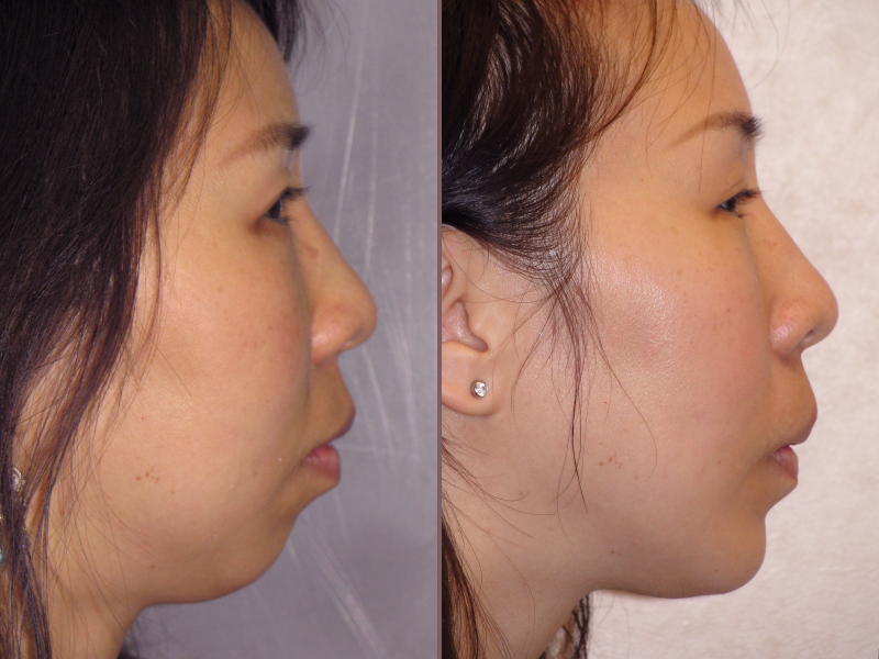 Chin Augmentation_00000.jpg