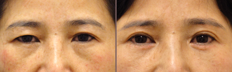 Asian Blepharoplasty_00006.jpg