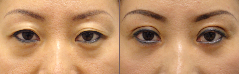 Asian Blepharoplasty_00007.jpg