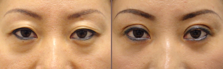 Asian+Blepharoplasty_00007.jpg