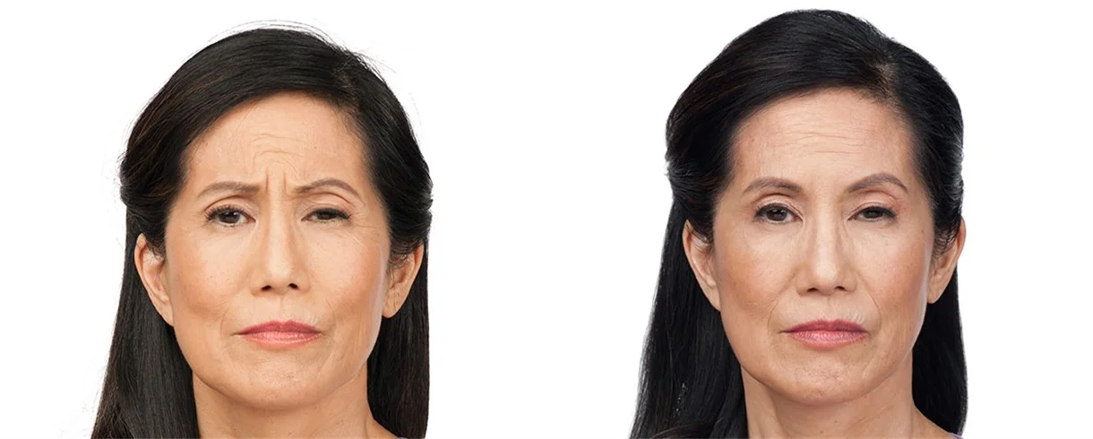 susan-front-before_副本.jpg