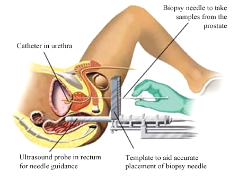 A safer way to biopsy the prostate