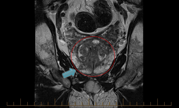 T2-weighted MRI of the prostate (circled) with PIRADS 5 lesion (arrow). Targeted biopsy of this lesion showed Gleason 5+5=10 prostate cancer.