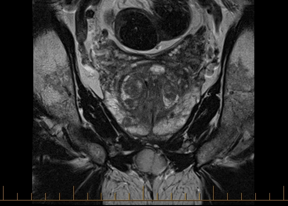 dr jeremy grummet mri prostate 1
