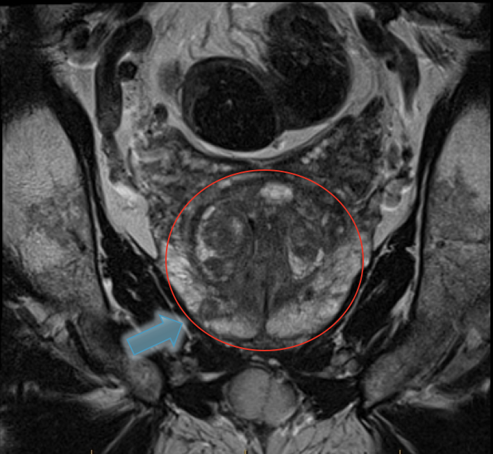 Multiparametric MRI of the prostate showing a cancer.