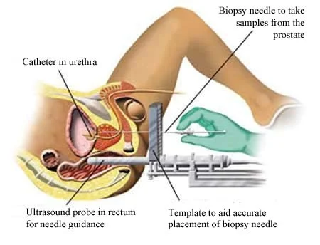 Transperineal biopsy - no needles in the rectum.