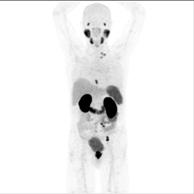 PSMA PET scanning shows multiple metastatic deposits of prostate cancer in lymph nodes.