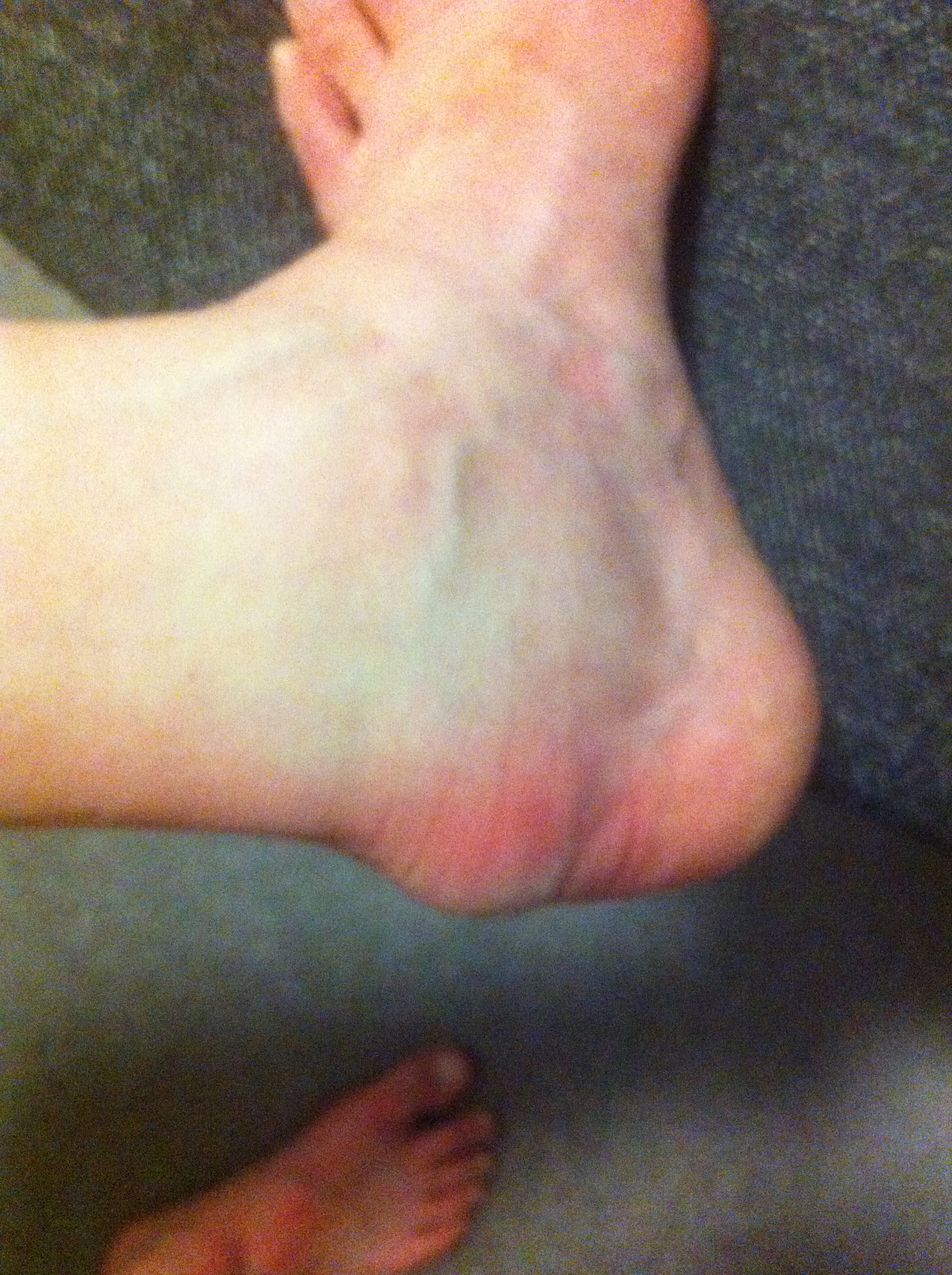 Nice and swollen ankle