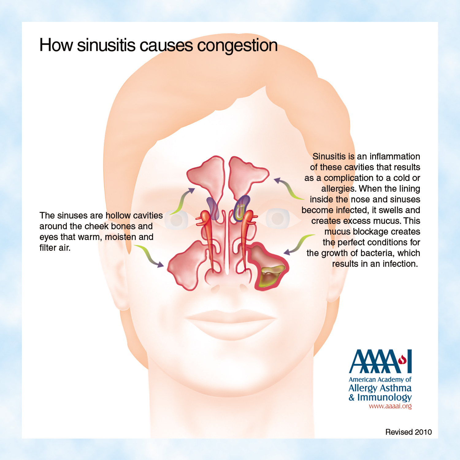 Sinus Infection (Sinusitis): Causes, Symptoms & Treatment