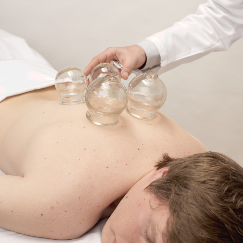 Cupping