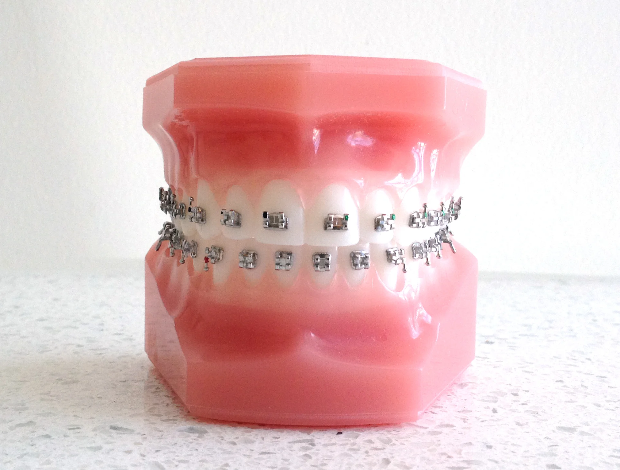 Traditional Metal Braces