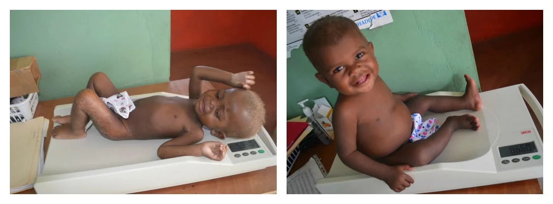 Andy before and after 6 weeks of Medika Mamba. 12.7 lbs and 18.9 lbs 
