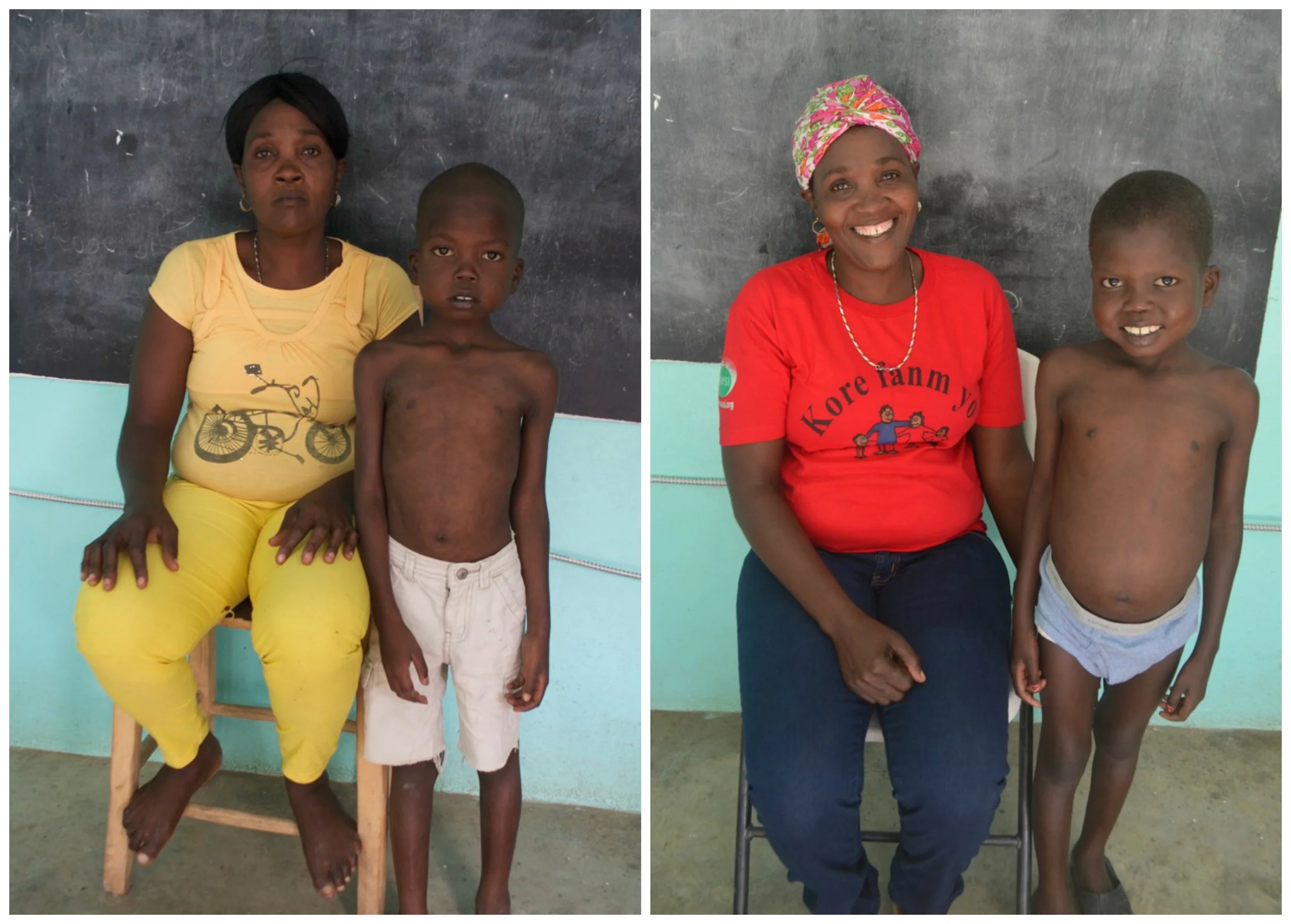 Kely and his Aunt before and after rehabilitation for Severe Acute Malnutrition