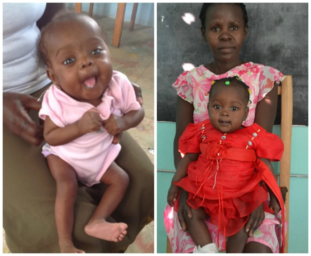 Daphnee during recovery (Day 20), and 6 months later