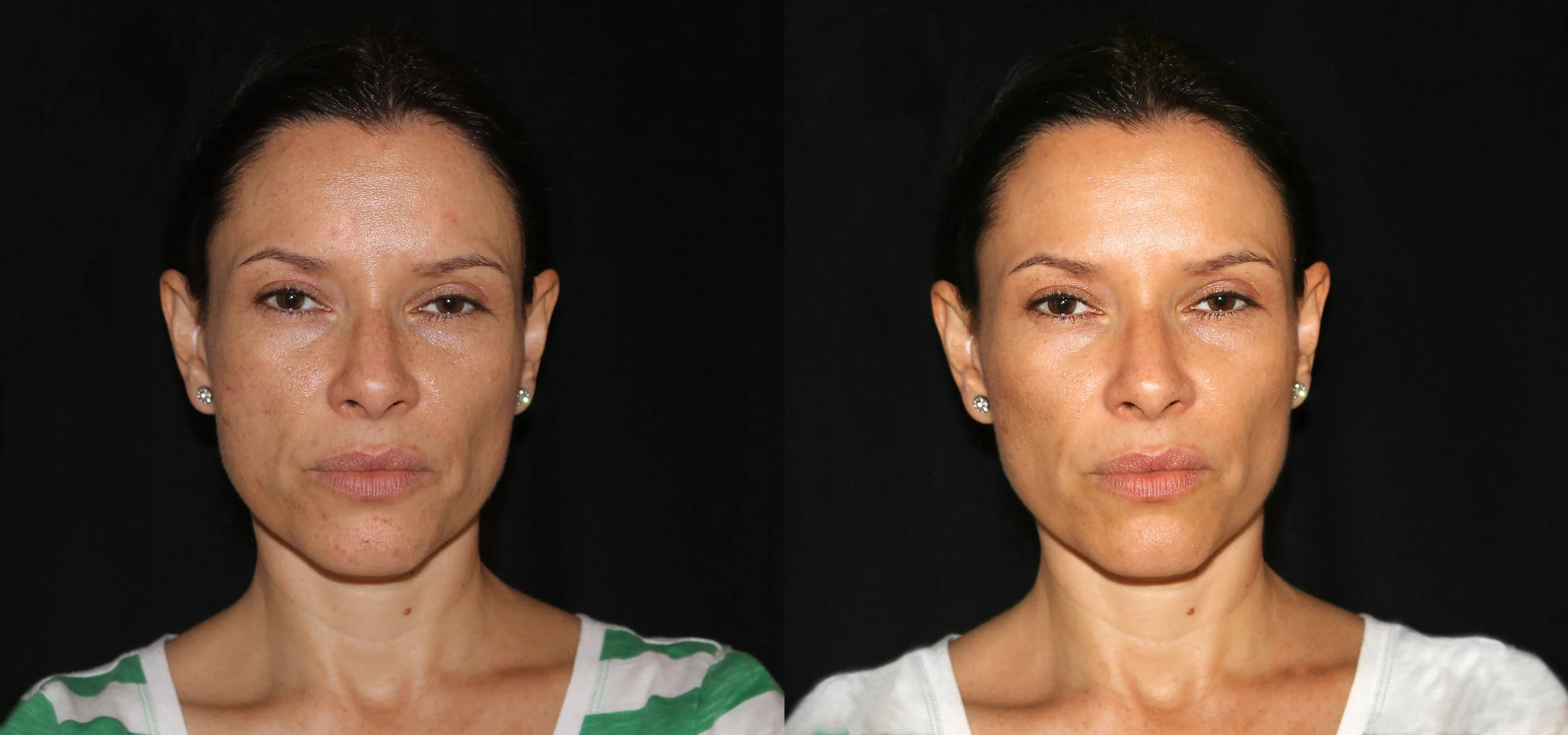 Uneven Skin Tone