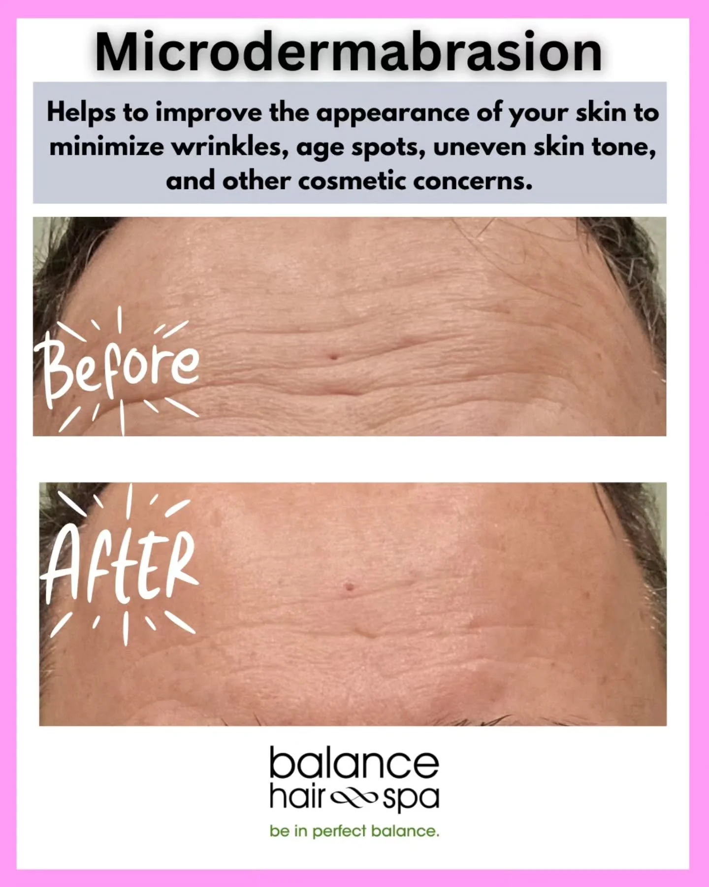 Have you had a microdermabrasion before? This non-invasive treatment exfoliates the top layer of skin using a diamond tip wand reducing wrinkles, acne scars, and sun damage for a refreshed, youthful look. It can be done as a stand alone service or ad