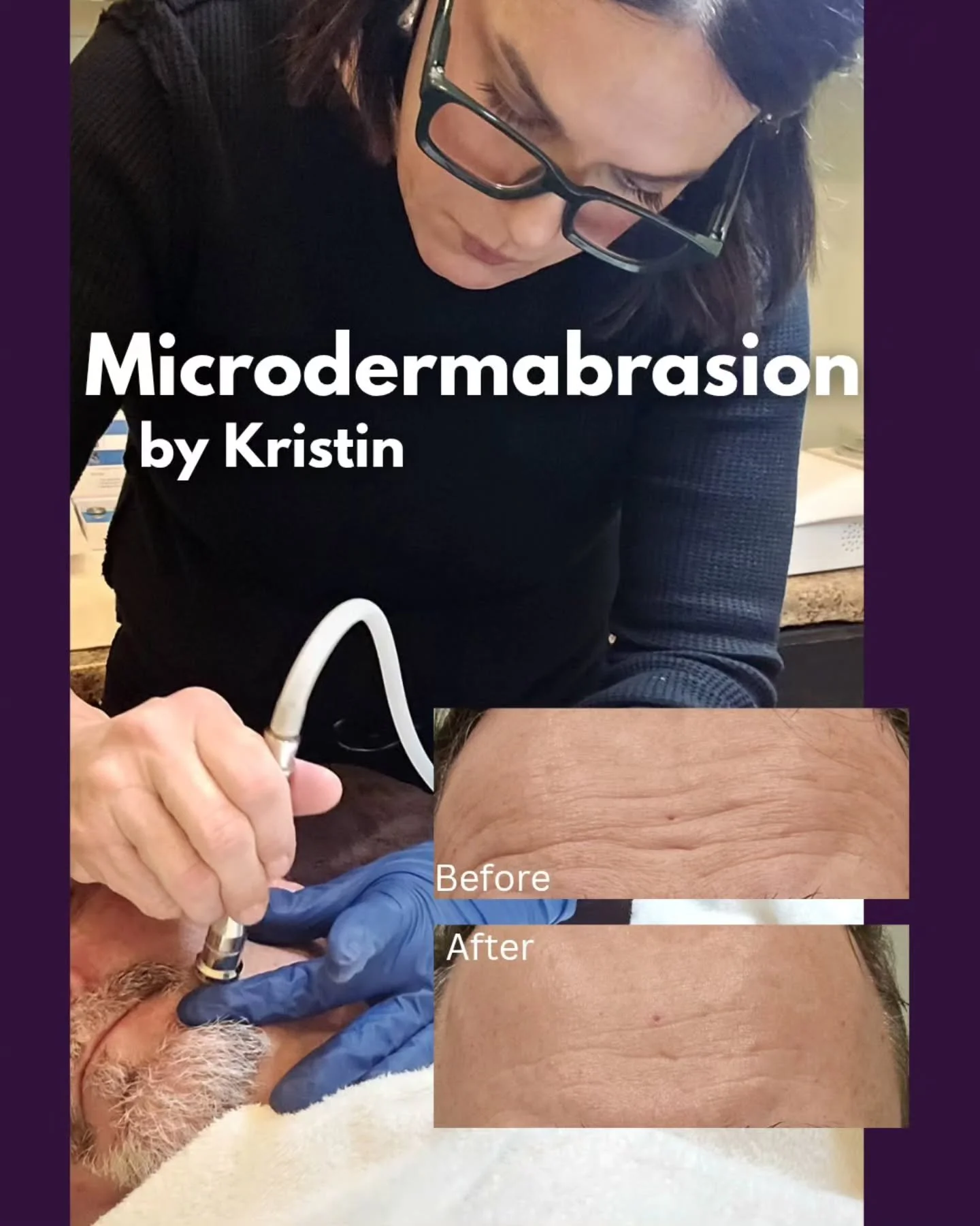 Microdermabrasion&nbsp;is&nbsp;a non-surgical, minimally invasive cosmetic procedure that exfoliates the skin by removing the thick, uneven outer layer. Using a diamond-tipped or crystal-emitting wand, it buffs away dead cells and suctions them away,