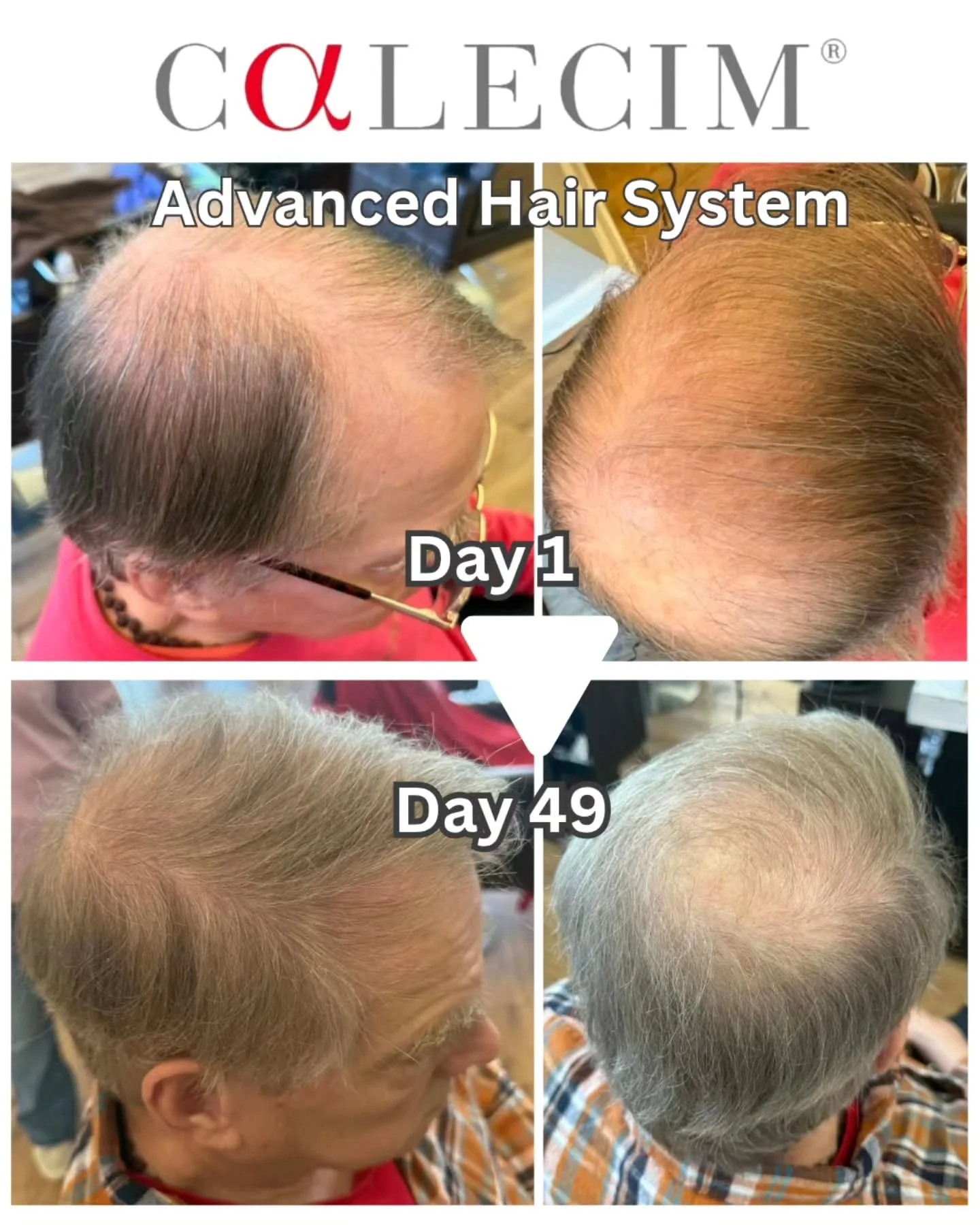 Clients have been amazed by the new Calecim Advanced Hair System. With new hair growth showing in a matter of a few weeks. This client is on week 7 of a 12 week plan. After week 12 he  will eventually go down to one treatment a week for a month then 