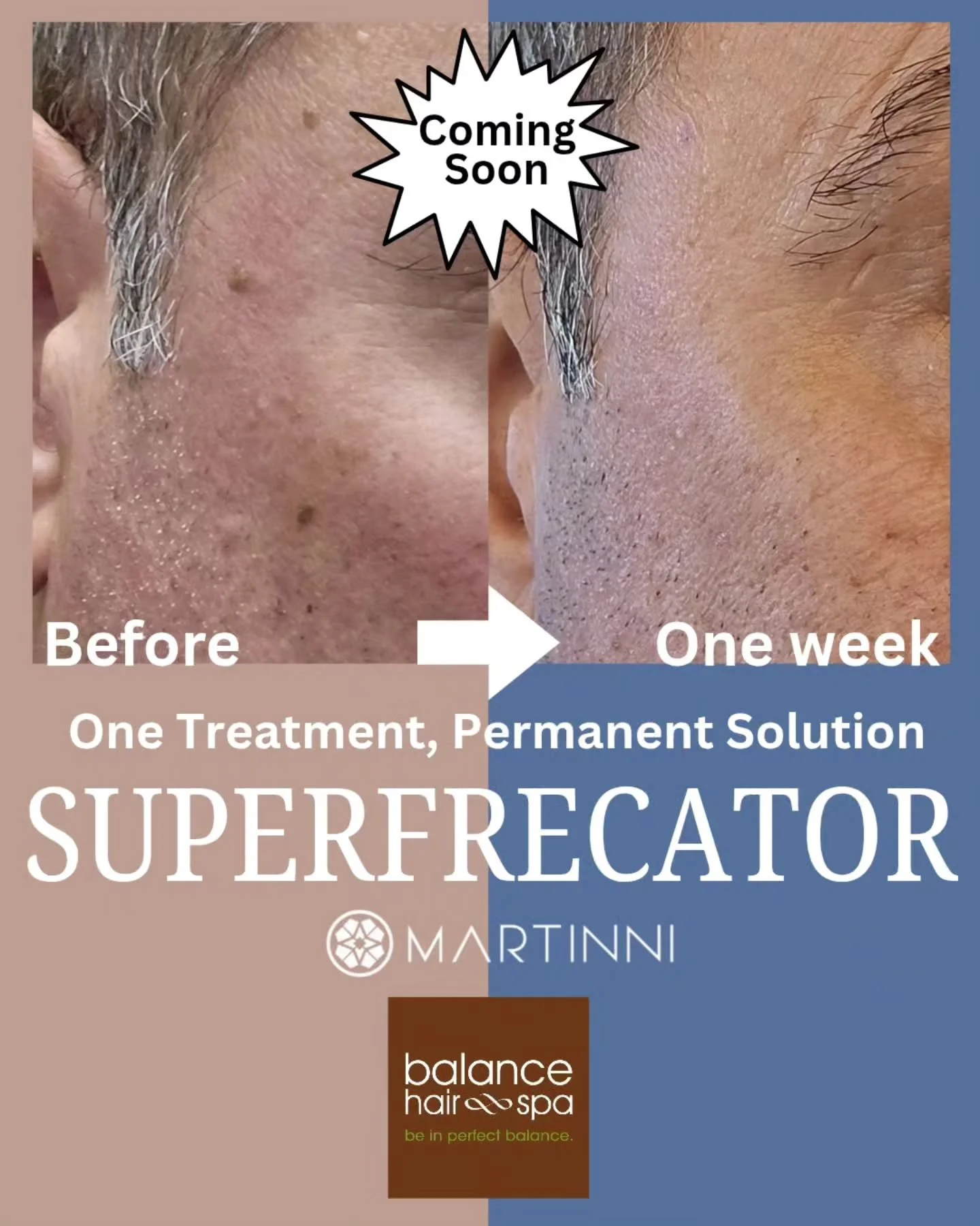 We are super excited to introduce our clients to a new treatment we will be offering next month in our spa. The Superfrecator by Martinni Beauty is a one treatment permanent solution to minor skin irregularities and anti-aging solutions. Look out for