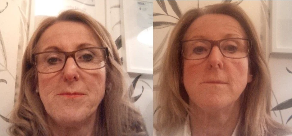 Natural Facelift - Before and After 6 Treatments