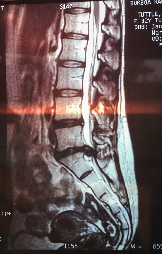 You can see where the disc is severely herniated in the lowest disc above my tailbones. (Between L5/S1 for those that know…) That large black protrusion should not be there. I also have a partially herniated disc above it in the L4/L5, but that one was left alone during surgery.