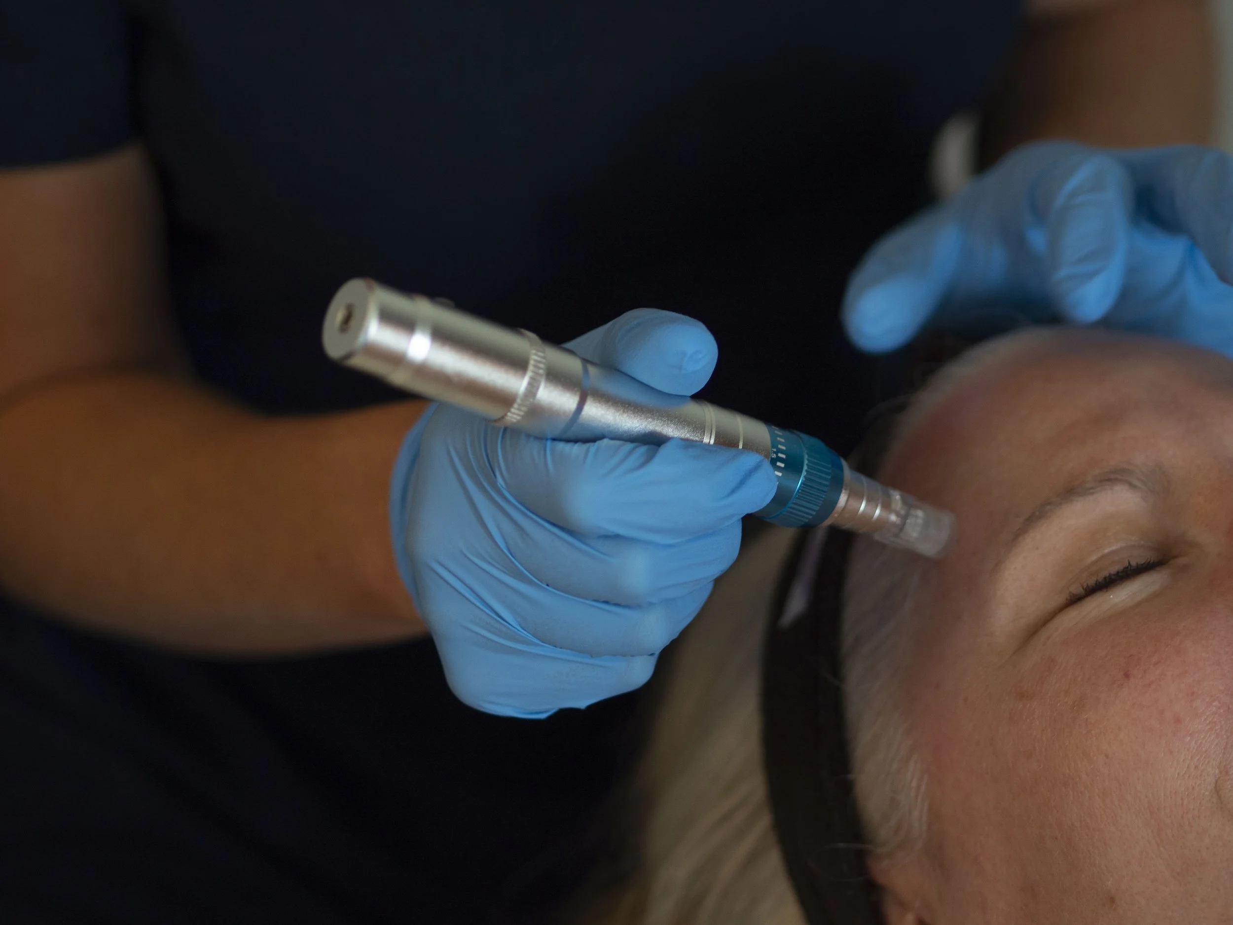 Cosmetic microneedling procedure on a person's forehead using a dermapen, with practitioner wearing blue gloves.