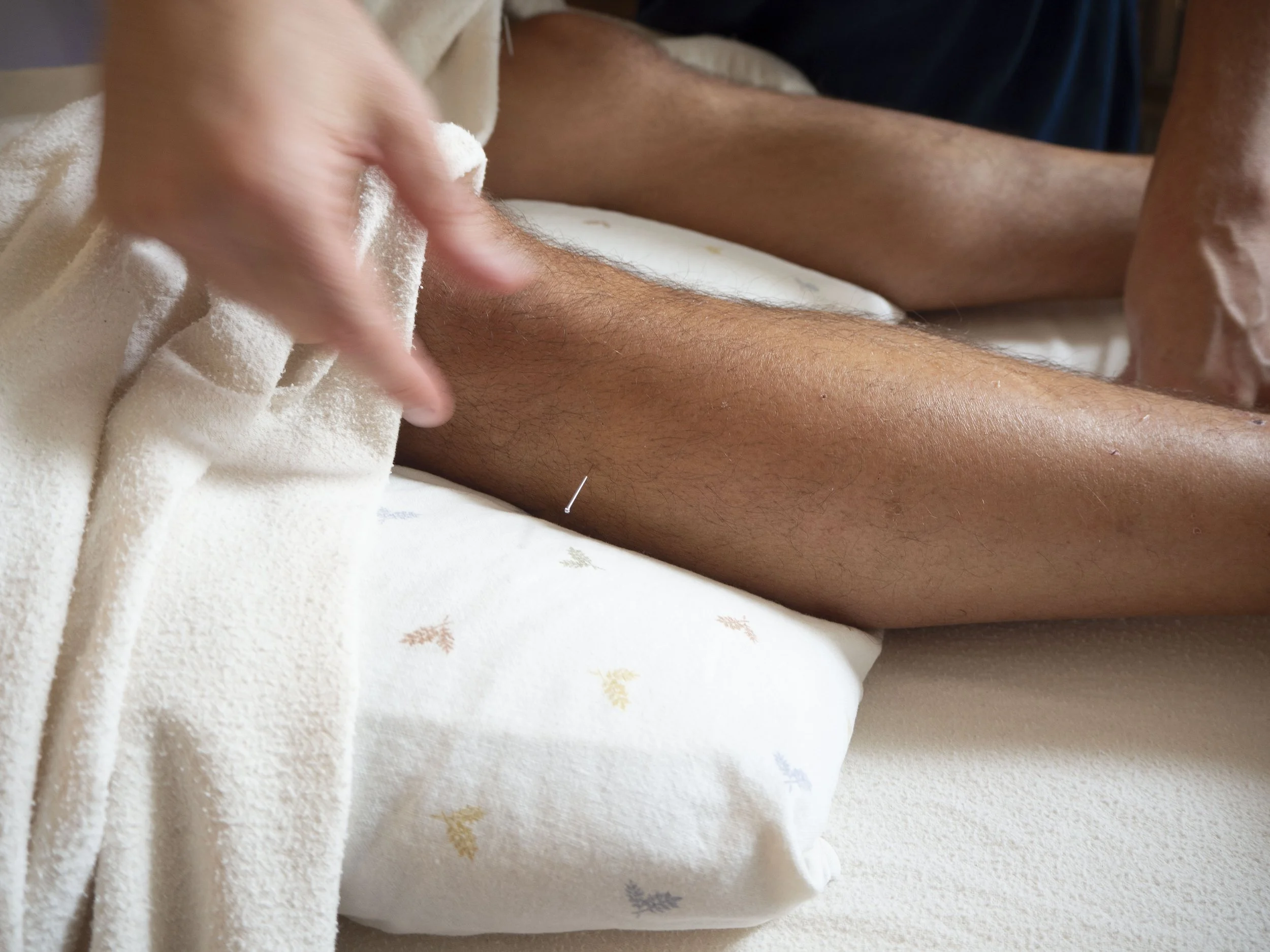 Person receiving acupuncture treatment on the leg.