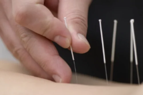 acupuncture.jpg