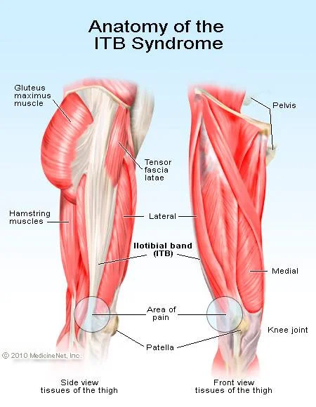 IT band Syndrome — Merrill Myopractics