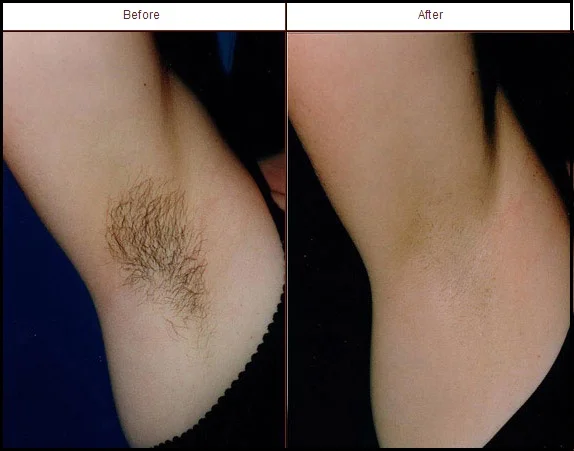 Laser Hair Removal The Skin Source