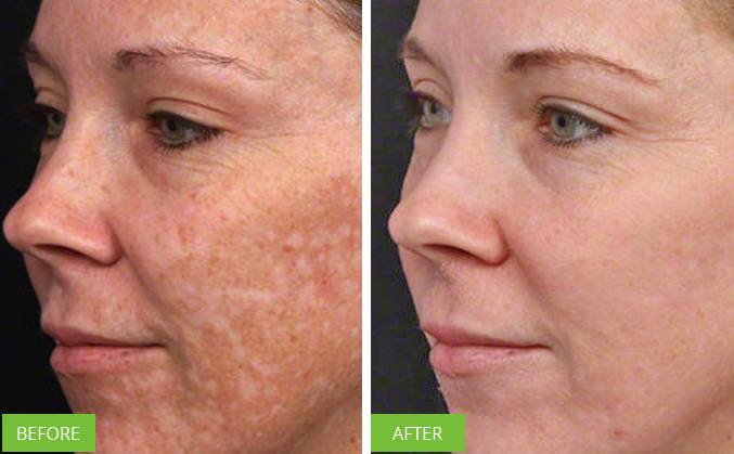 melasma 2.JPG