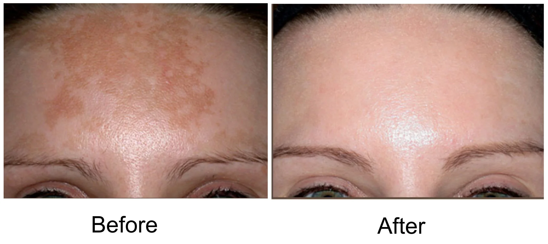 ipl skin rejuvenation near me