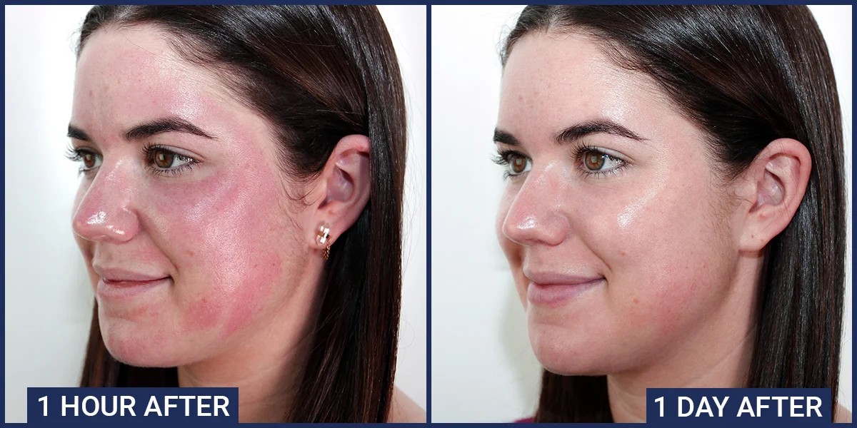 Microneedling & Advanced Microneedling RF — The Skin Source