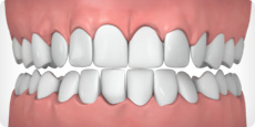 Overly Crowded Teeth