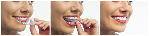 Invisalign clear aligners are a discreet way to straigten your teeth.