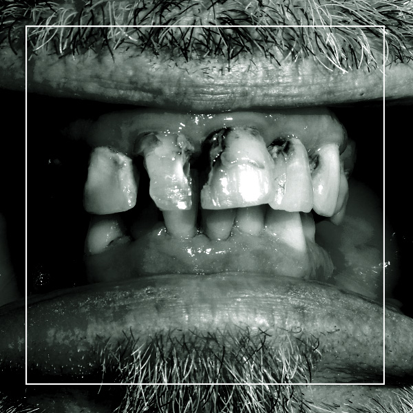 Cosmetic denture patient Carl before treatment