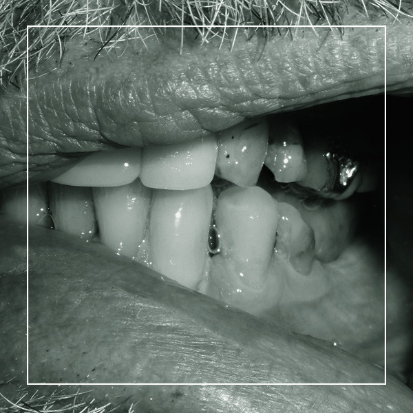 Cosmetic denture patient James before treatment