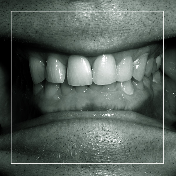 Dave before TMJ treatment and cosmetic dental restoration.