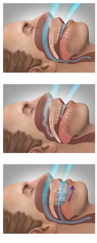 Illustration of Obstructive Sleep Apnea and how wearing MicrO2 sleep and snore device.