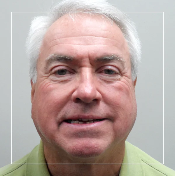 Copy of Before Custom Porcelain Restorations