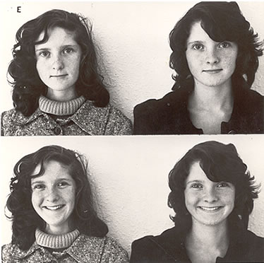 A tale of identical twins. The twin on the left had four bicuspids extracted and the twin on the right did not. Both went through treatment and the difference is clear with treatment provided more fullness and esthetic beauty.