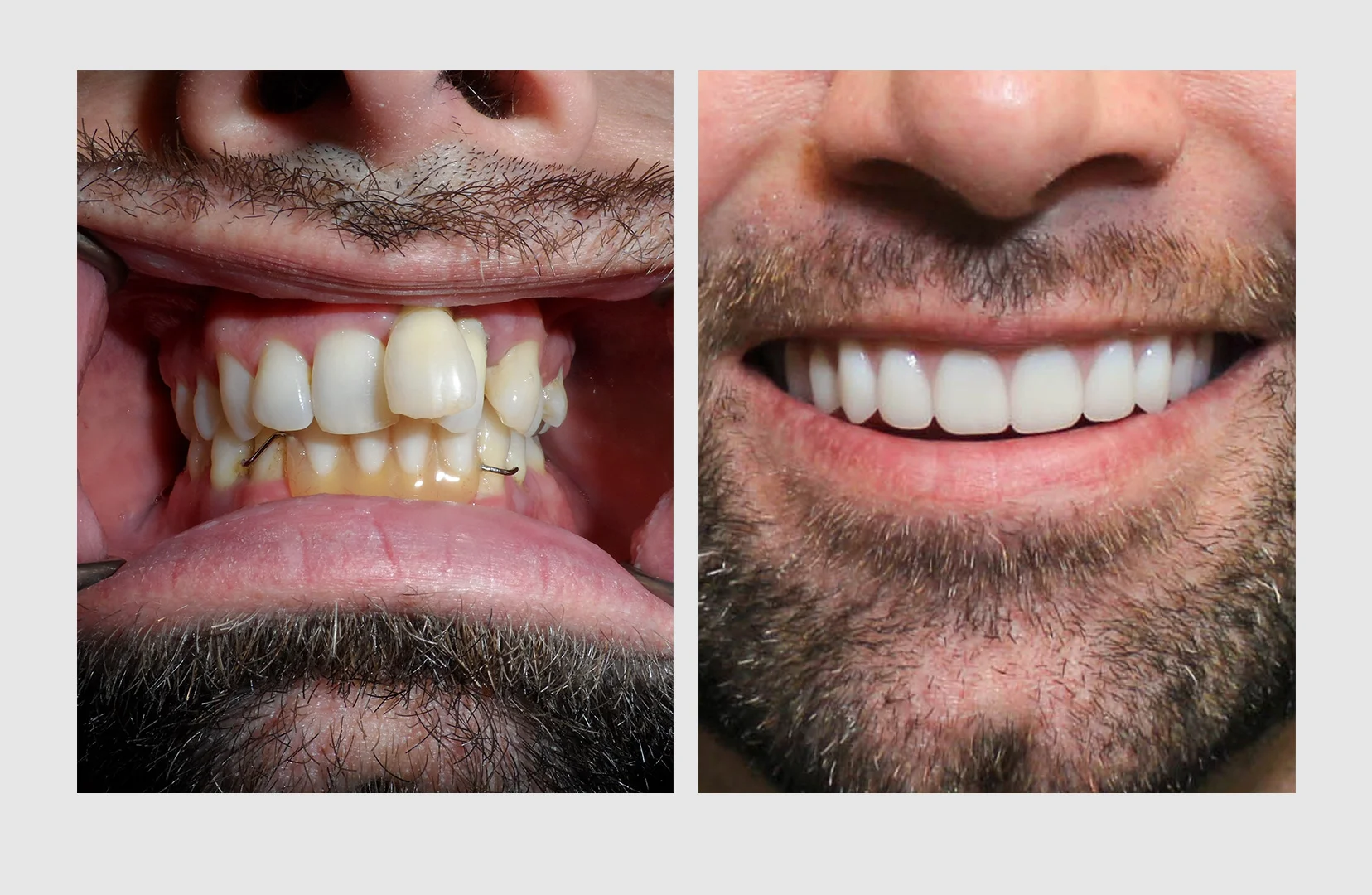 Cosmetic Dentures — Smile Doctor | Randi Green DMD, LVIF