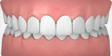 Overbite