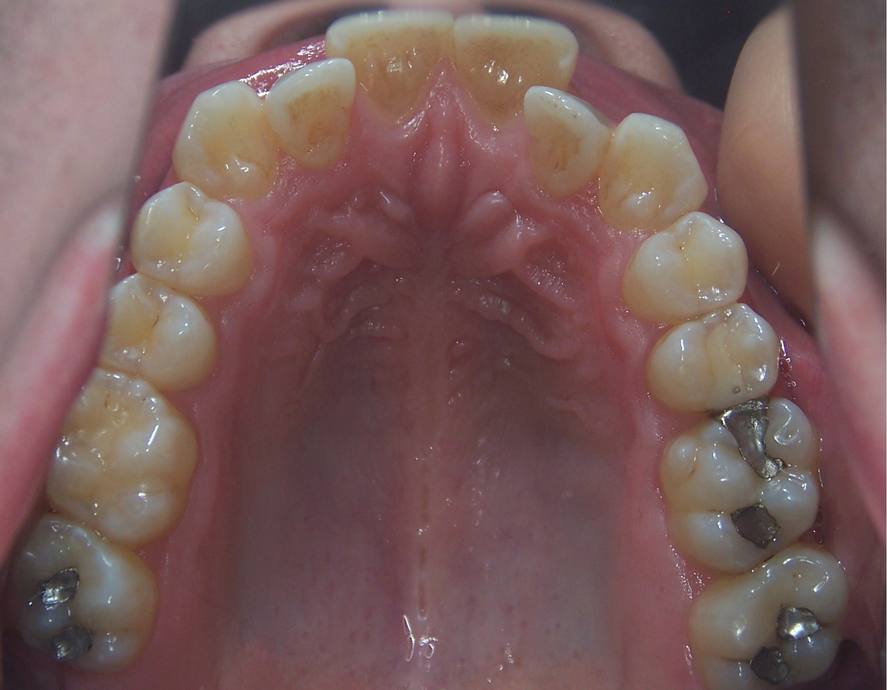 Post industrial upper arch and teeth of a mouth breather. The tongue wasn't on the roof of the mouth resulting in a narrow upper arch and crowded teeth.