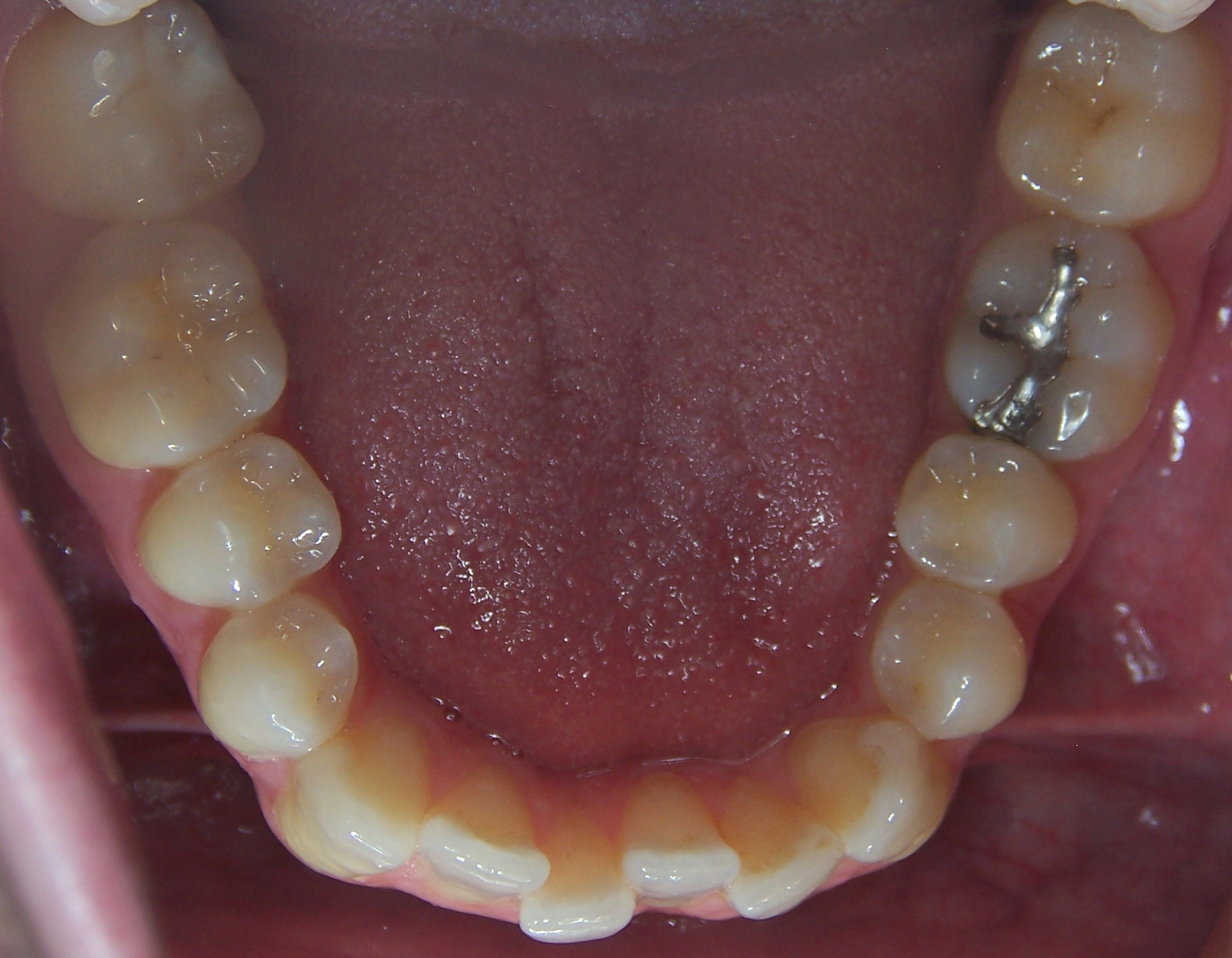 Post industiral lower arch and teeth of of a mouth breather. Notice the tipped in back teeth from the tongue resting on them during eruption.