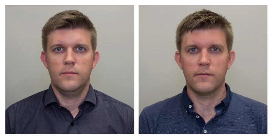 Forward No Smile — Left on Day 2 / Right on Day 30