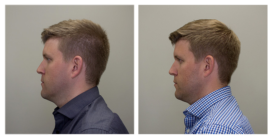 Left Face — Left on Day 2 / Right on Day 70