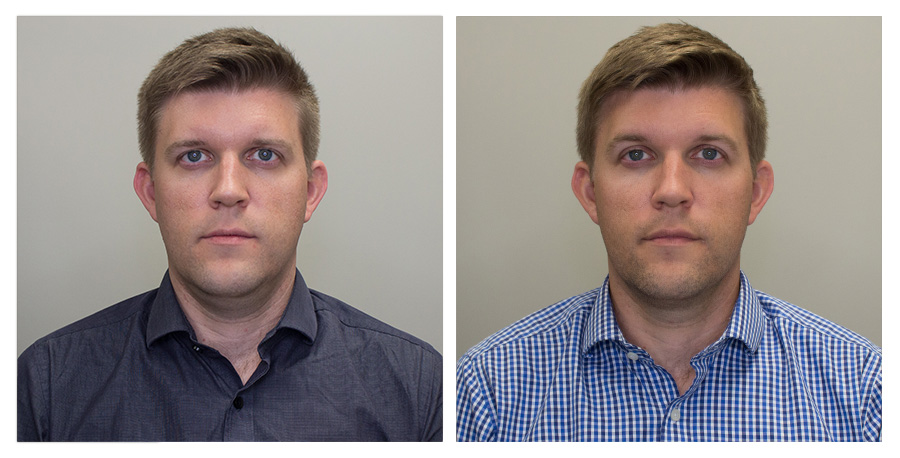 Forward No Smile — Left on Day 2 / Right on Day 70