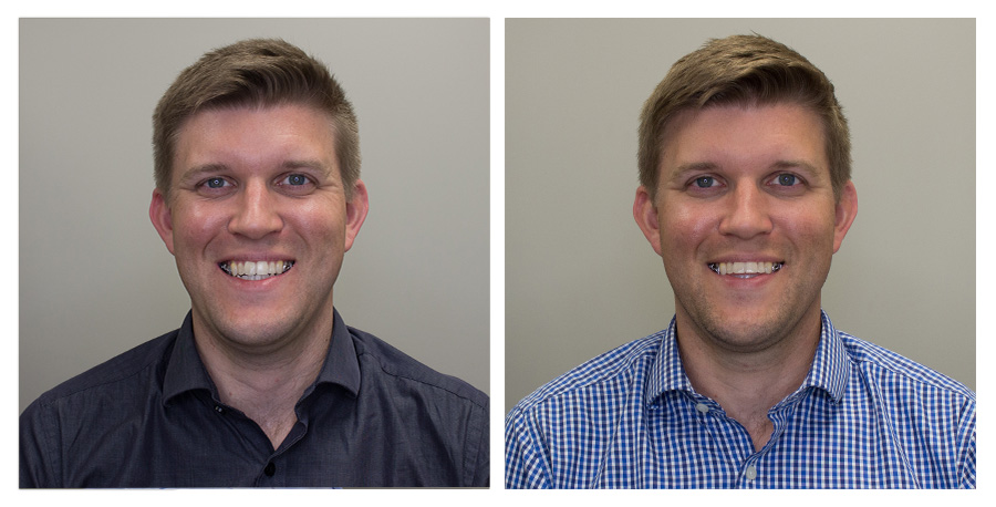 Forward No Smile — Left on Day 2 / Right on Day 70